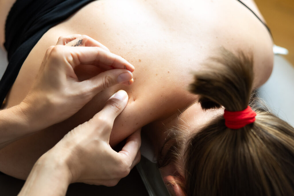 Dry Needling bei einer Patientin